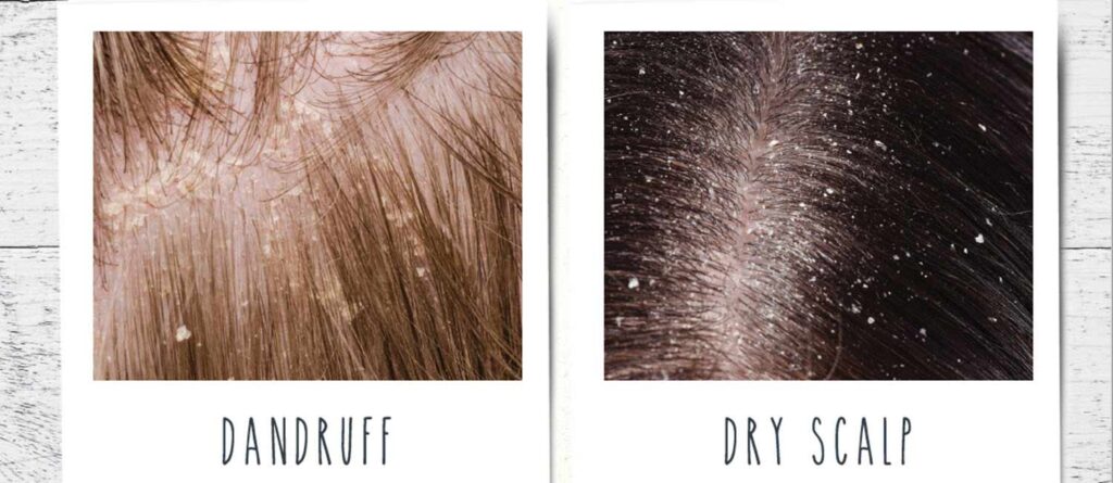 dry scalp vs dandruff